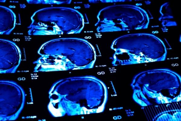 Does CBD Help Those With Anxiety And Depression?